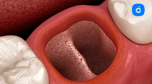 alveolitis