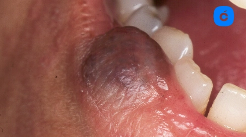 angioma