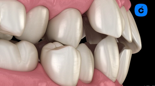 apiñamiento dental