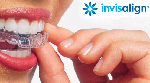precio invisalign