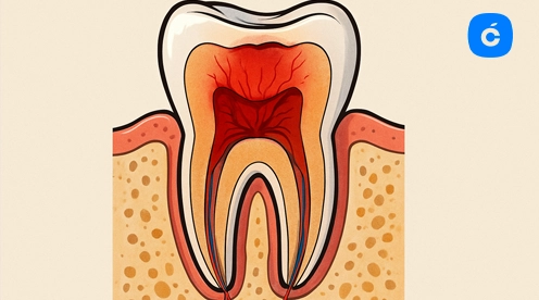 pulpitis