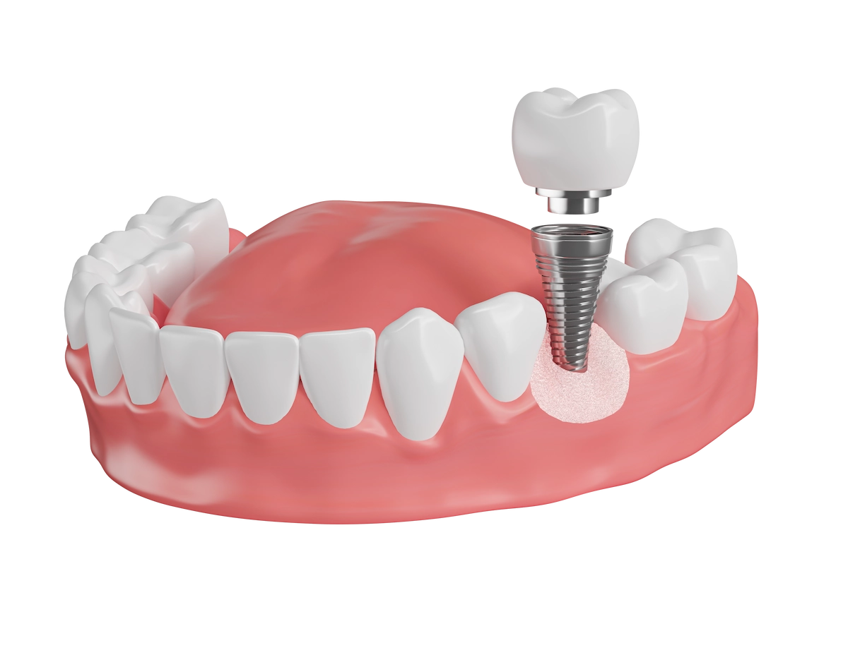 Implante con poco hueso