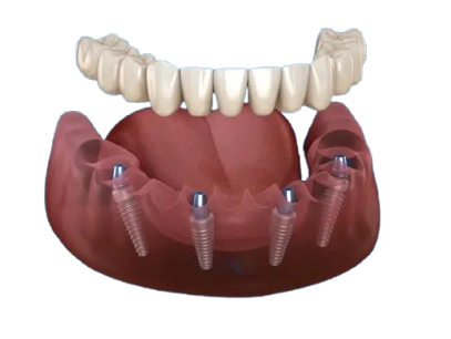 all on 4 1 removebg preview