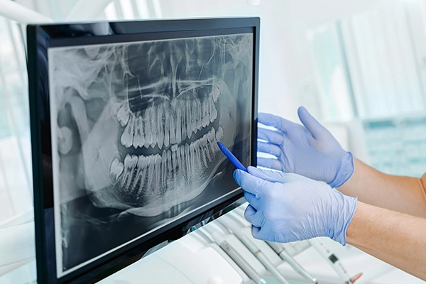 antes de la cirugia implantes