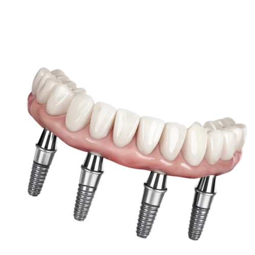 implante all on 4 soy candidato