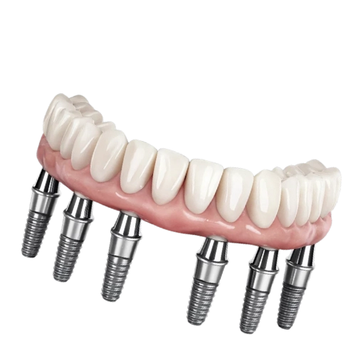 implante all on 6 (1)