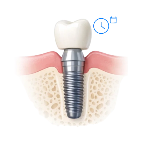 implante convencional cuanto tarda