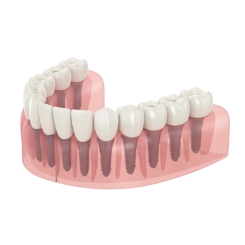 implantes boca completa (2)