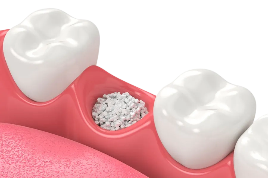 implantes con poco hueso