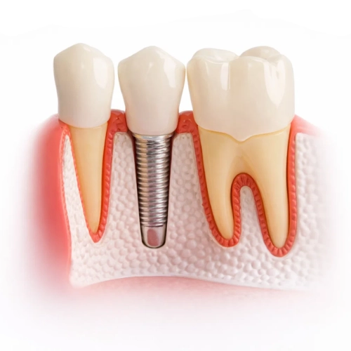 implantes poco hueso