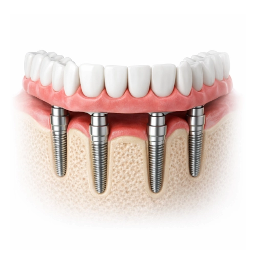 que son los implantes dentales all on 4