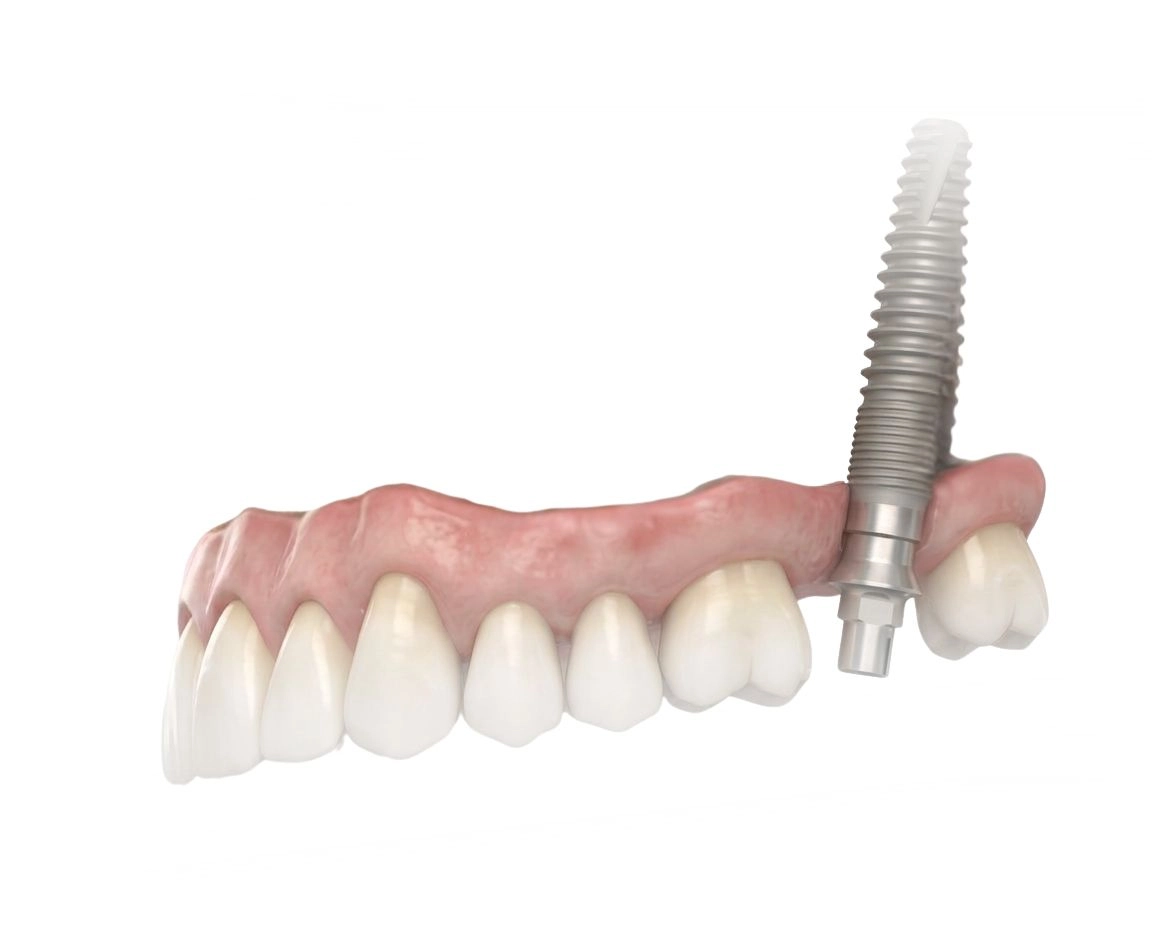 Implantes pterigoideos (2)