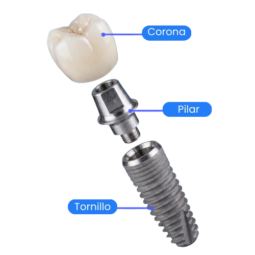 partes de un implante dental