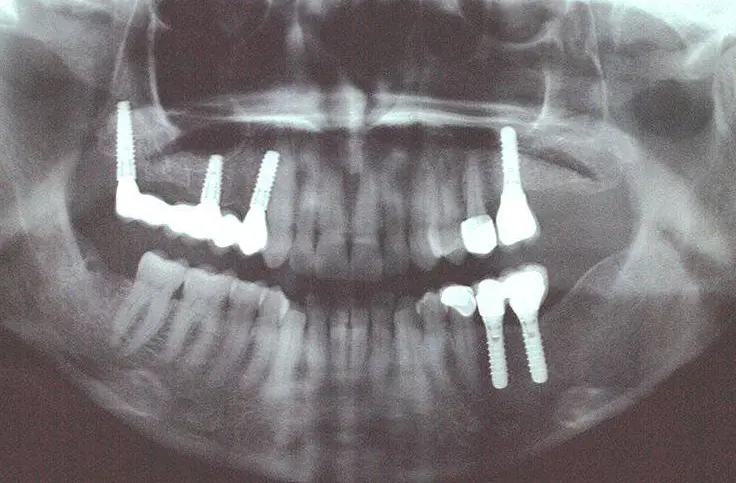 Dientes fijos sin hueso