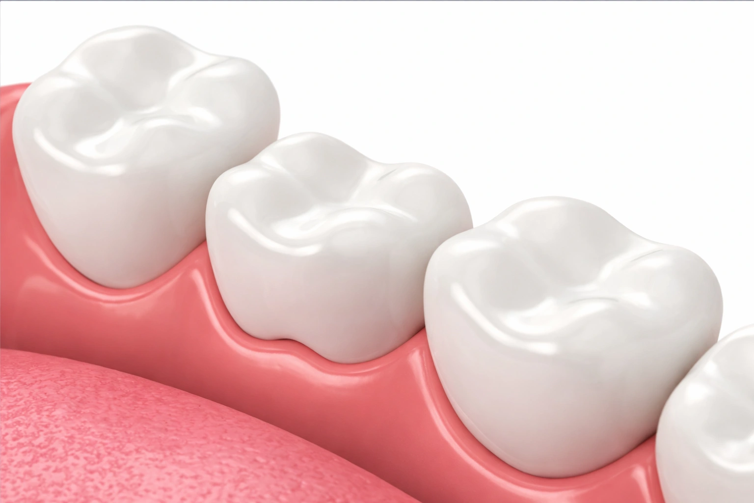 Puente dental fijo en dientes naturales